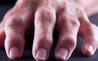 Чем лечить артрит кистей рук