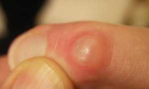 Гигрома пальца симптомы