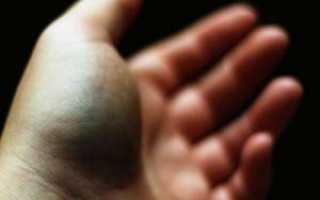 Лечение суставов пальцев рук народными средствами