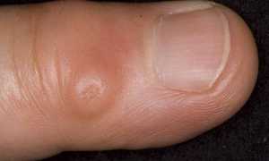 Гигрома пальца симптомы