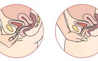 Кольцо-контрацептив НоваРинг