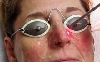 Лечение купероза на лице современными методами: лазером, ЭЛОС и фотовспышкой