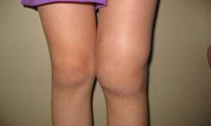Отек ноги выше колена причины и лечение