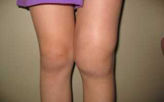 Отек ноги выше колена причины и лечение