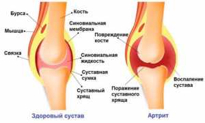 Таблетки при артрите коленного сустава