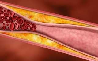 Лечение повышенной нормы холестерина в крови