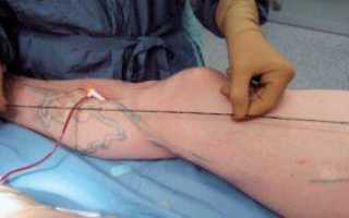 Как делается операция на удаление вен на ногах