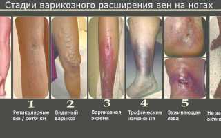 Покраснение кожи и красные пятна на ногах при варикозе: методы лечения