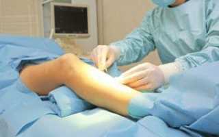 Что такое варикозные узлы на ногах и как их лечить