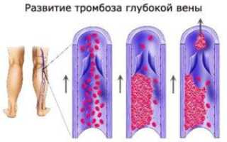 Что такое тромбоз нижних конечностей: фото симптомов и лечение