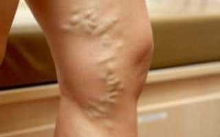 К чему приводит варикозное расширение вен на ногах у женщин