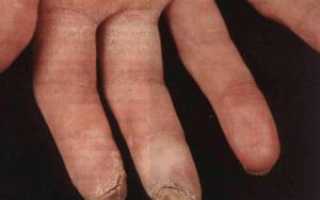 Облитерирующий Тромбангиит (болезнь Бюргера): фото симптомов и лечение