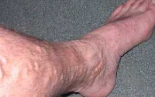 Венозный застой в ногах: симптомы и лечение