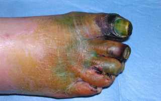 Заболевания сосудов ног: симптомы и лечение