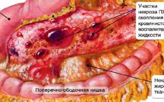 Панкреатит – болезнь поджелудочной железы