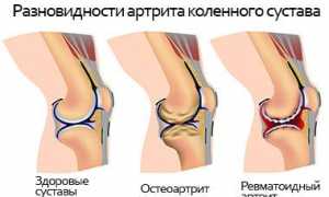 Боль при разгибании коленного сустава