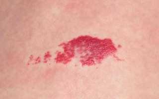 Причины возникновения гемангиомы у взрослых на коже